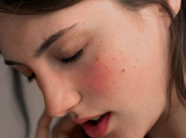 Imagen categoría piel sensible con una mujer con ojos cerrados y piel enrojecida 